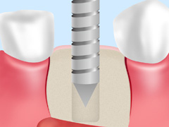 インプラント手術