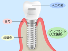 インプラント治療とは
