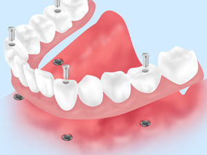 歯の状態別・治療例
