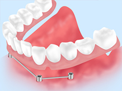 インプラントを用いた入れ歯～インプラントオーバーデンチャー～